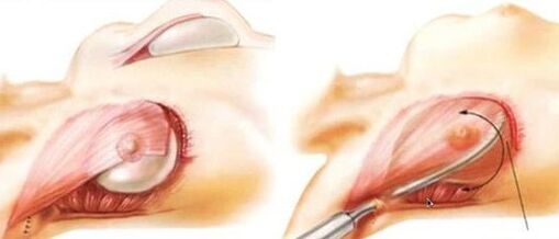 How breast augmentation operation is performed