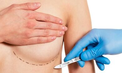 Submammaric access to breast enlargement with implants
