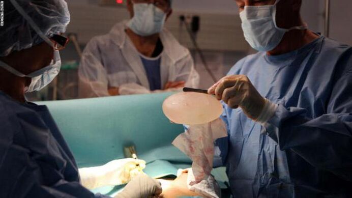Features of mammoplasty