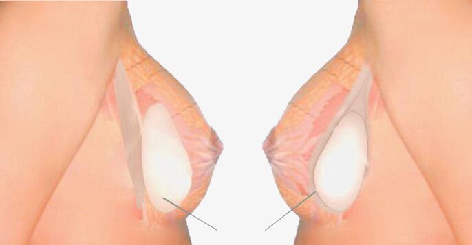 What is mammoplasty