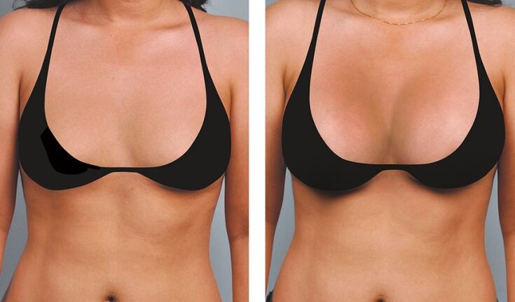 photos before and after breast enlargement