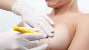 breast augmentation surgery