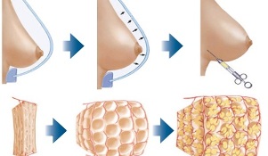 how is breast augmentation procedure performed with fat